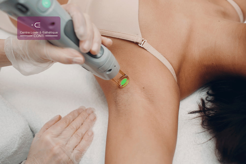 aisselle epilation laser definitive