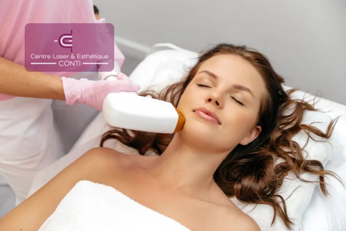 epilation visage laser