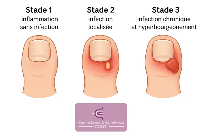 Comment soigner un ongle incarné ? Que faire ? Traitement naturel